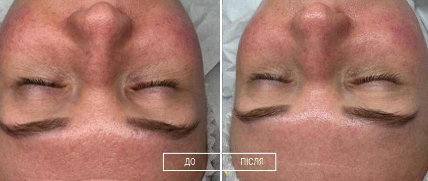 EXO SKIN REPAIR. Регенерирующая экзосомальная процедура 