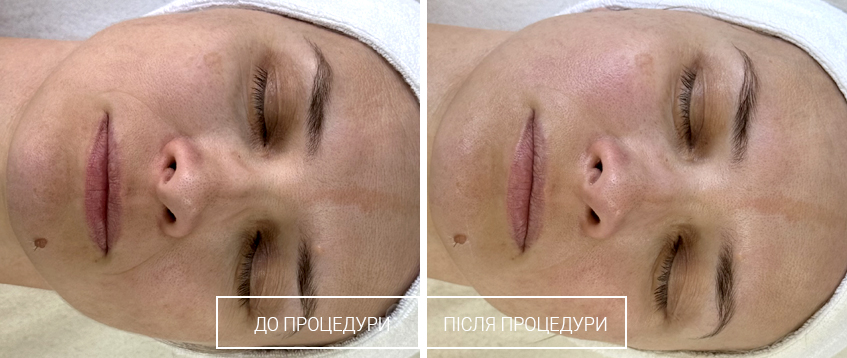 Осветляющий регенерирующий уход для коррекции пигментации различного генеза